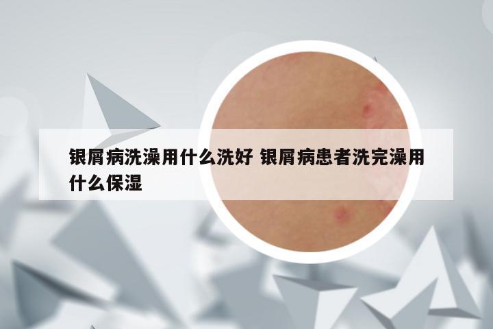 银屑病洗澡用什么洗好 银屑病患者洗完澡用什么保湿