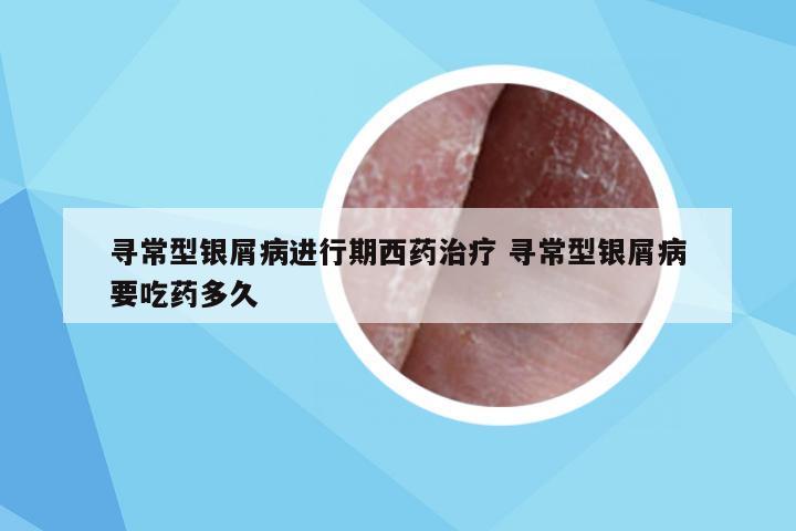 寻常型银屑病进行期西药治疗 寻常型银屑病要吃药多久