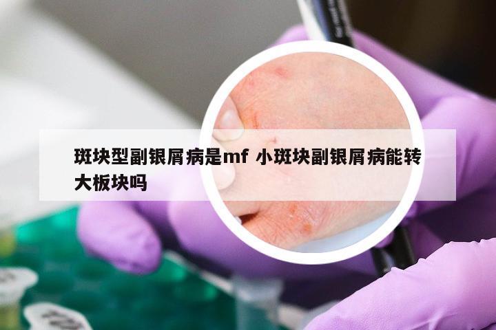 斑块型副银屑病是mf 小斑块副银屑病能转大板块吗