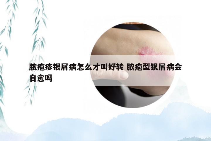 脓疱疹银屑病怎么才叫好转 脓疱型银屑病会自愈吗