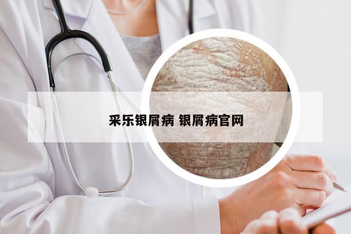 采乐银屑病 银屑病官网