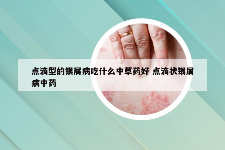 点滴型的银屑病吃什么中草药好 点滴状银屑病中药