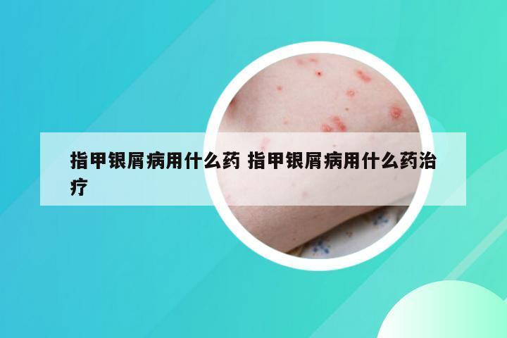 指甲银屑病用什么药 指甲银屑病用什么药治疗