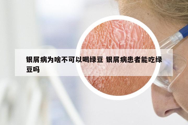 银屑病为啥不可以喝绿豆 银屑病患者能吃绿豆吗