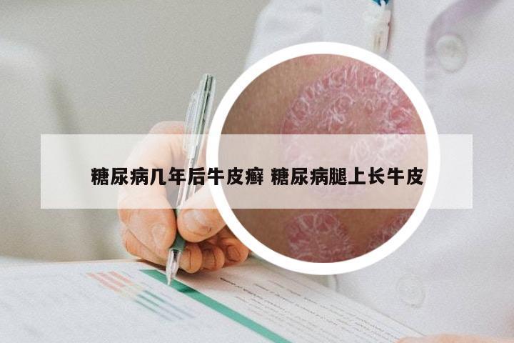 糖尿病几年后牛皮癣 糖尿病腿上长牛皮