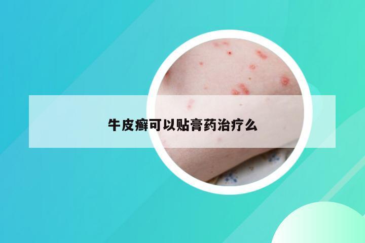 牛皮癣可以贴膏药治疗么