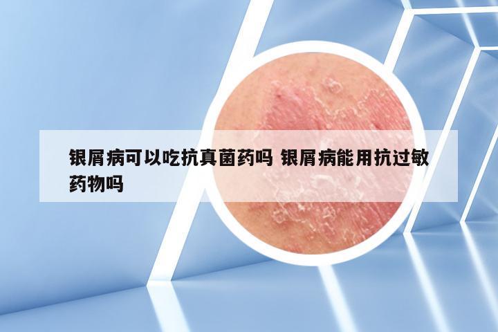 银屑病可以吃抗真菌药吗 银屑病能用抗过敏药物吗