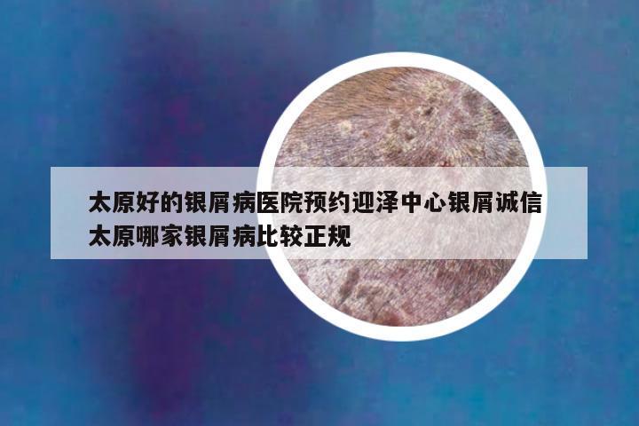 太原好的银屑病医院预约迎泽中心银屑诚信 太原哪家银屑病比较正规