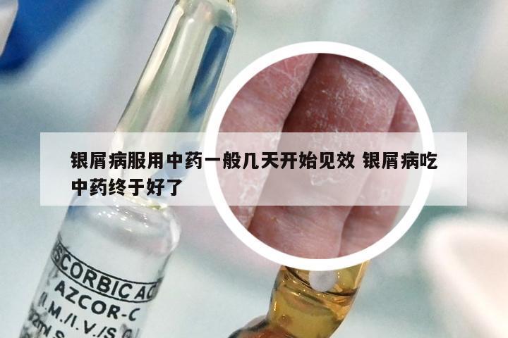 银屑病服用中药一般几天开始见效 银屑病吃中药终于好了