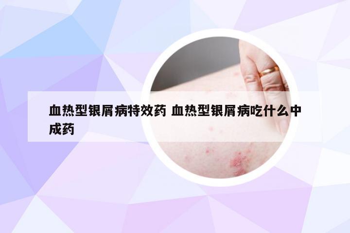 血热型银屑病特效药 血热型银屑病吃什么中成药