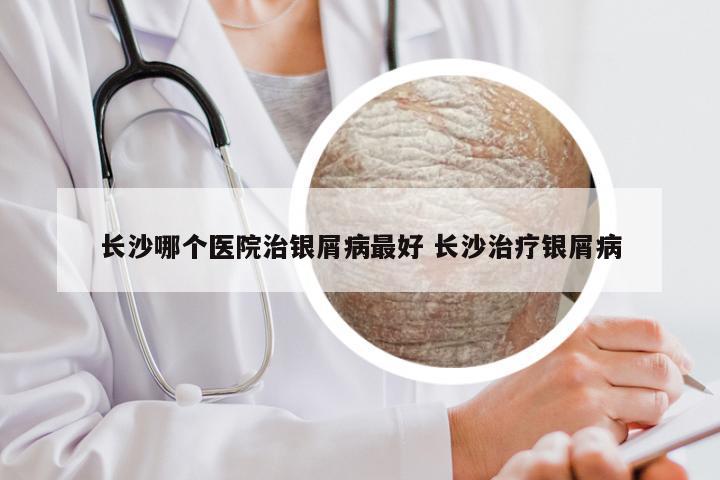 长沙哪个医院治银屑病最好 长沙治疗银屑病