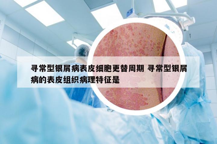 寻常型银屑病表皮细胞更替周期 寻常型银屑病的表皮组织病理特征是