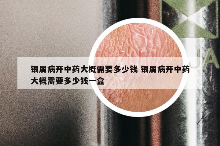 银屑病开中药大概需要多少钱 银屑病开中药大概需要多少钱一盒