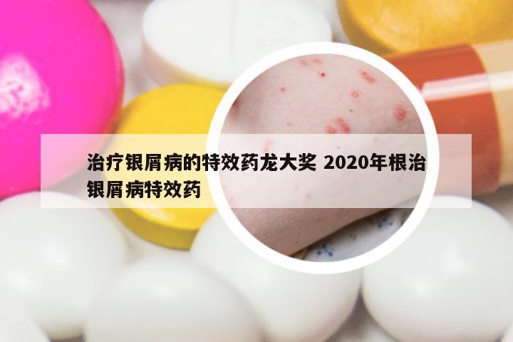 治疗银屑病的特效药龙大奖 2020年根治银屑病特效药