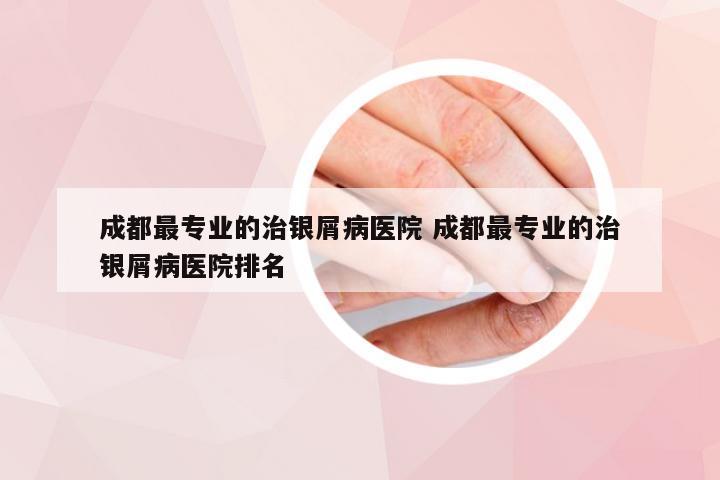 成都最专业的治银屑病医院 成都最专业的治银屑病医院排名