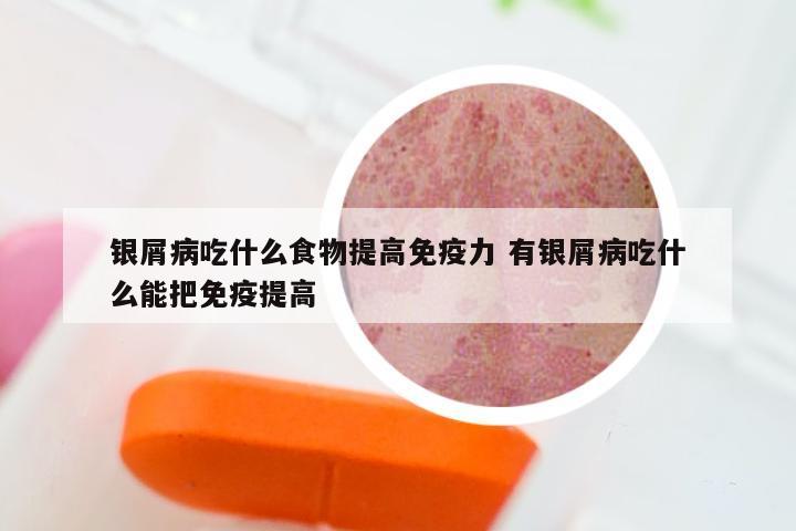 银屑病吃什么食物提高免疫力 有银屑病吃什么能把免疫提高