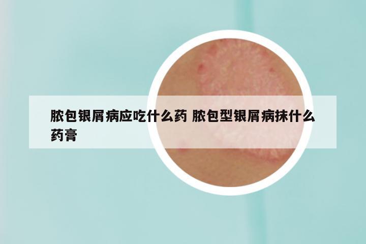 脓包银屑病应吃什么药 脓包型银屑病抹什么药膏