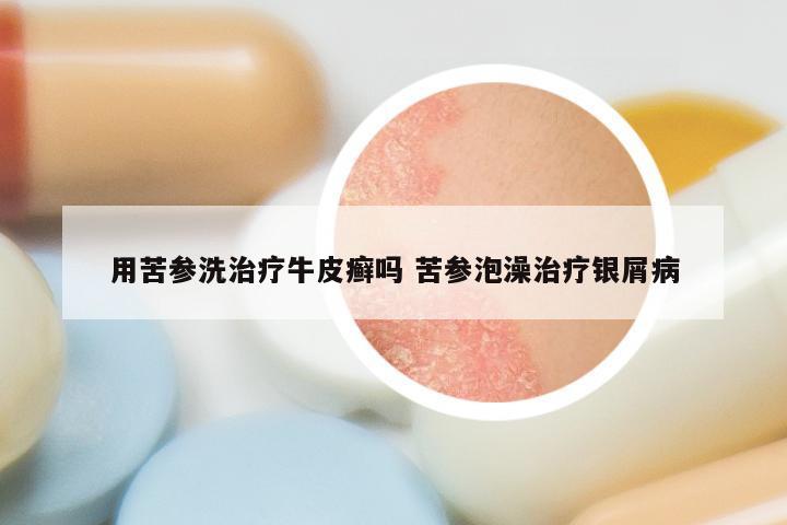 用苦参洗治疗牛皮癣吗 苦参泡澡治疗银屑病