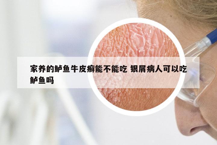 家养的鲈鱼牛皮癣能不能吃 银屑病人可以吃鲈鱼吗