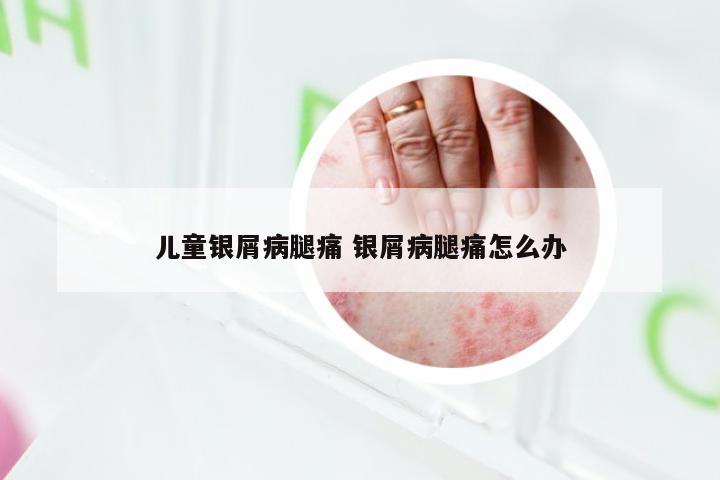 儿童银屑病腿痛 银屑病腿痛怎么办