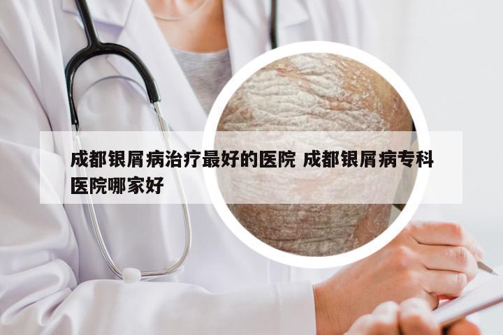 成都银屑病治疗最好的医院 成都银屑病专科医院哪家好