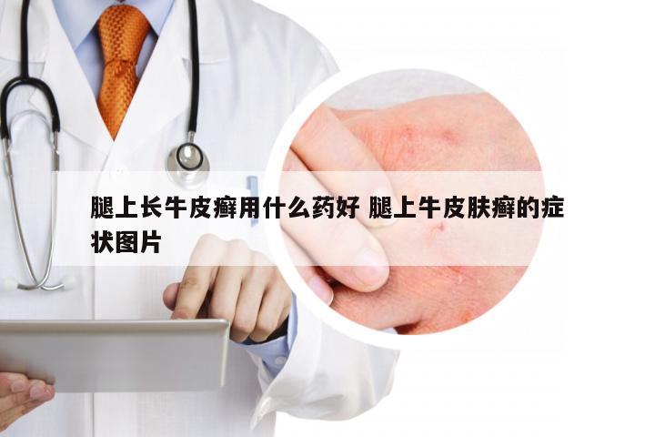 腿上长牛皮癣用什么药好 腿上牛皮肤癣的症状图片