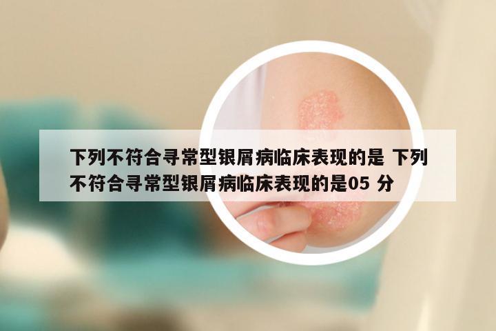 下列不符合寻常型银屑病临床表现的是 下列不符合寻常型银屑病临床表现的是05 分