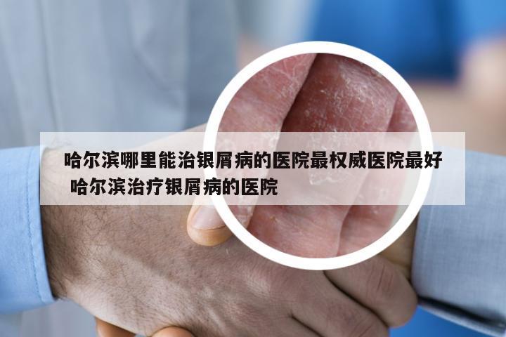 哈尔滨哪里能治银屑病的医院最权威医院最好 哈尔滨治疗银屑病的医院