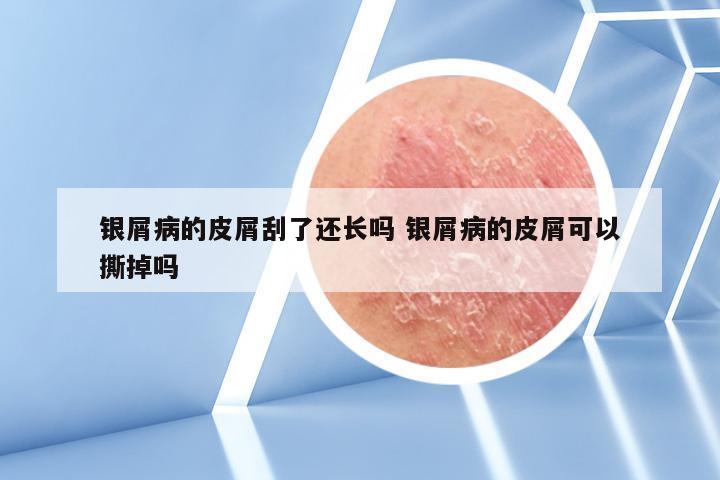 银屑病的皮屑刮了还长吗 银屑病的皮屑可以撕掉吗