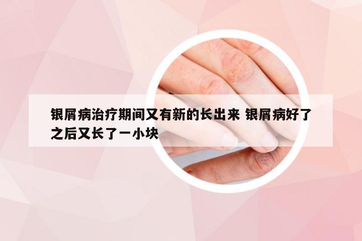 银屑病治疗期间又有新的长出来 银屑病好了之后又长了一小块