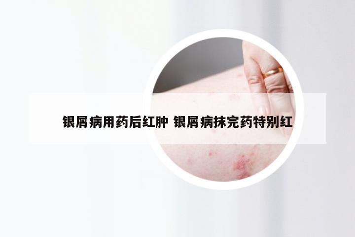 银屑病用药后红肿 银屑病抹完药特别红