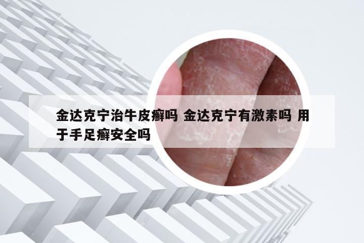 金达克宁治牛皮癣吗 金达克宁有激素吗 用于手足癣安全吗