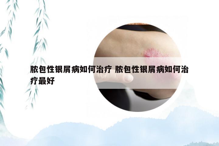 脓包性银屑病如何治疗 脓包性银屑病如何治疗最好