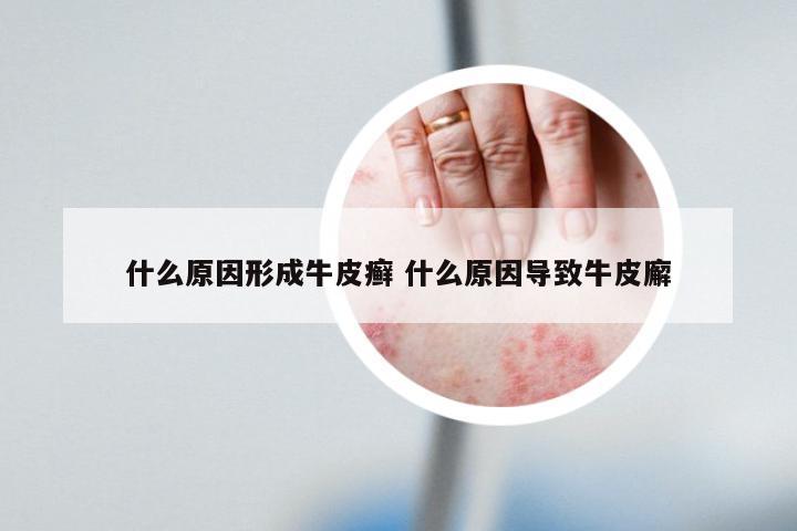 什么原因形成牛皮癣 什么原因导致牛皮廨