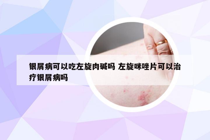 银屑病可以吃左旋肉碱吗 左旋咪唑片可以治疗银屑病吗