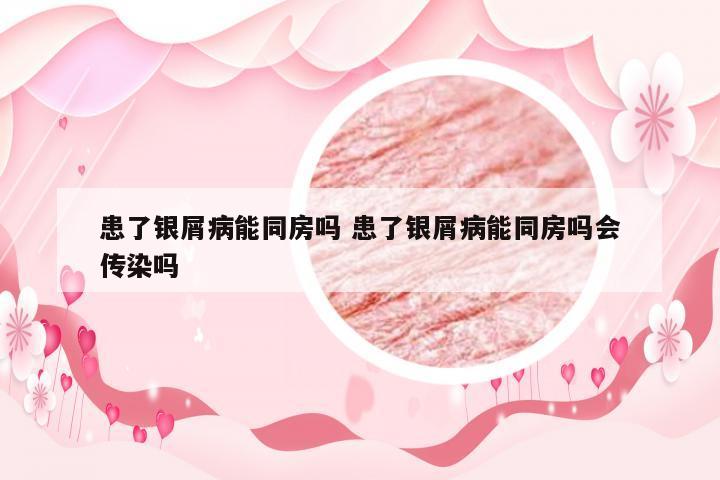 患了银屑病能同房吗 患了银屑病能同房吗会传染吗