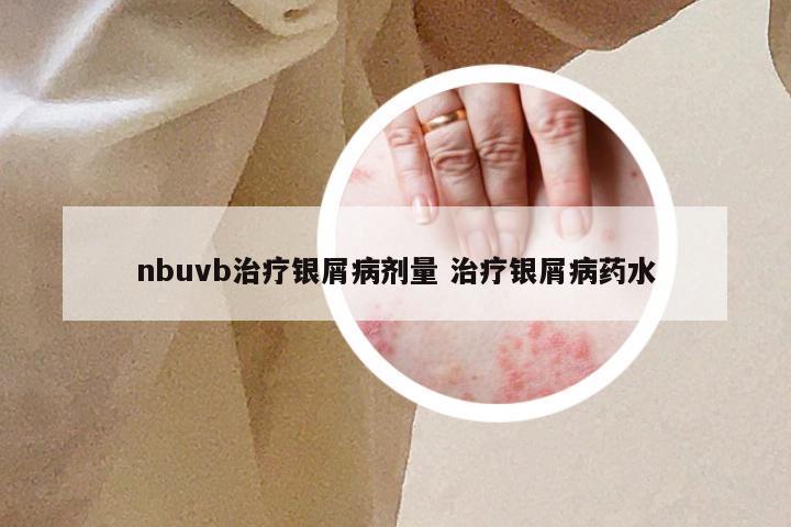 nbuvb治疗银屑病剂量 治疗银屑病药水