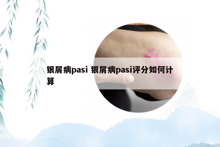 银屑病pasi 银屑病pasi评分如何计算