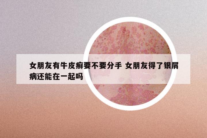 女朋友有牛皮癣要不要分手 女朋友得了银屑病还能在一起吗