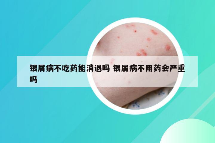 银屑病不吃药能消退吗 银屑病不用药会严重吗