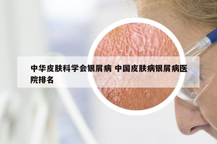 中华皮肤科学会银屑病 中国皮肤病银屑病医院排名