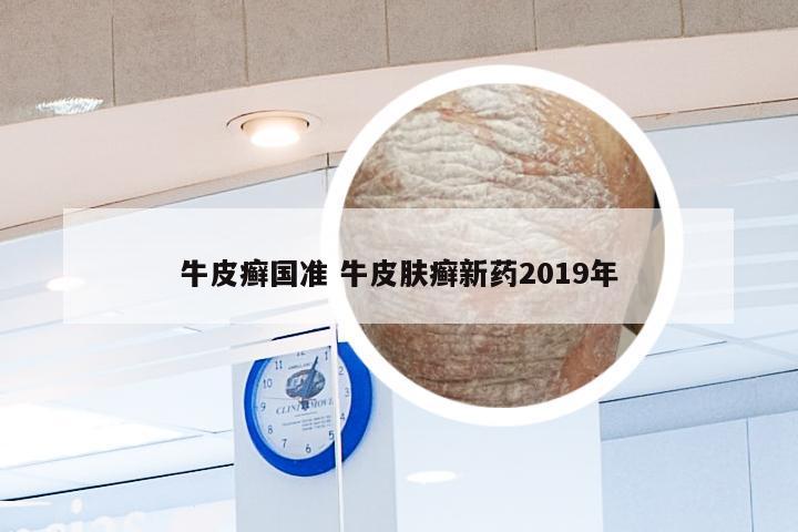 牛皮癣国准 牛皮肤癣新药2019年