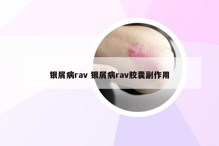 银屑病rav 银屑病rav胶囊副作用