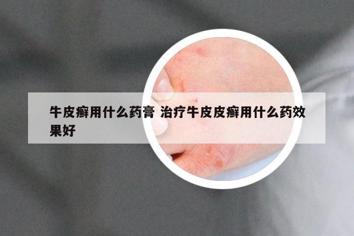 牛皮癣用什么药膏 治疗牛皮皮癣用什么药效果好