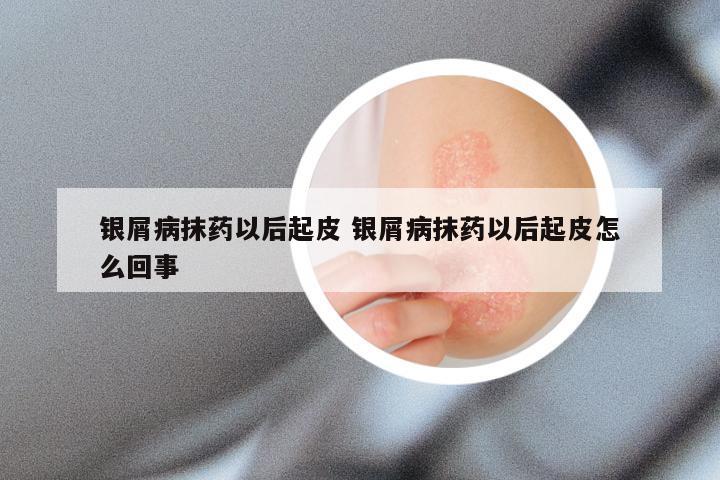 银屑病抹药以后起皮 银屑病抹药以后起皮怎么回事