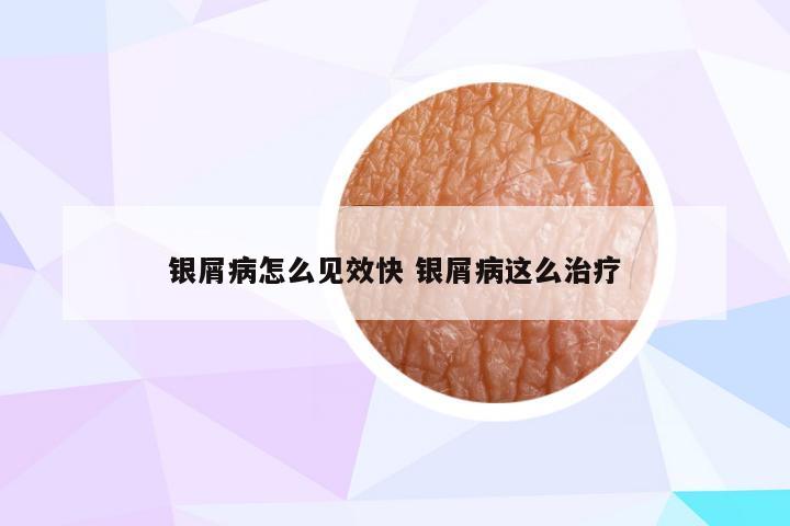 银屑病怎么见效快 银屑病这么治疗