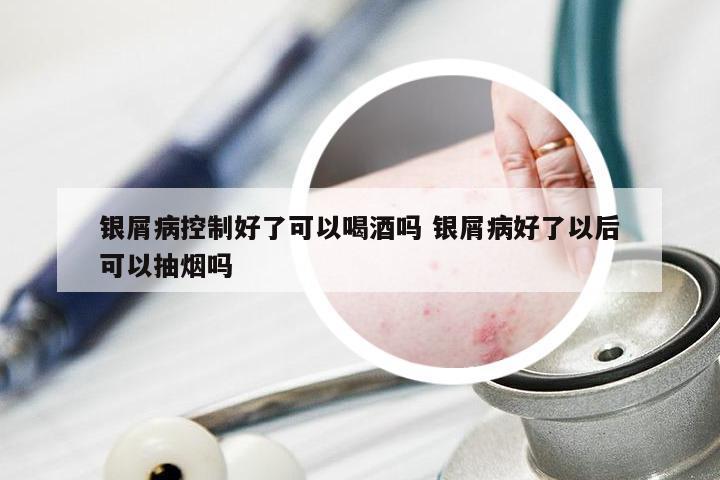 银屑病控制好了可以喝酒吗 银屑病好了以后可以抽烟吗