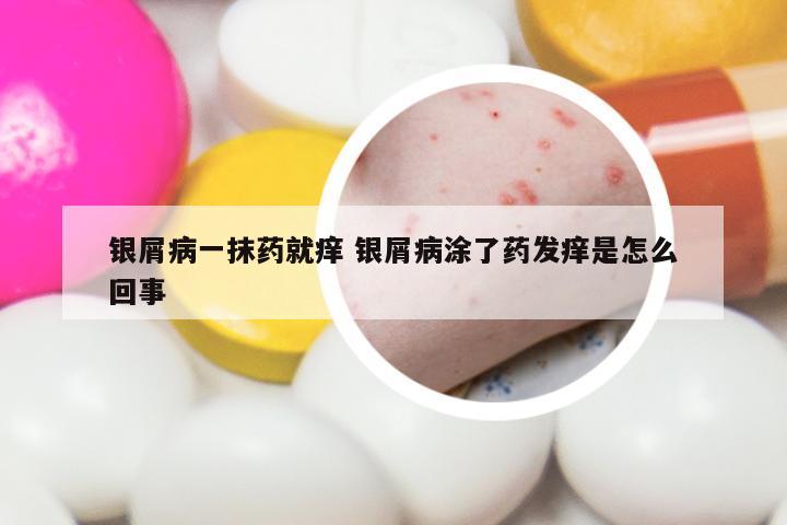 银屑病一抹药就痒 银屑病涂了药发痒是怎么回事