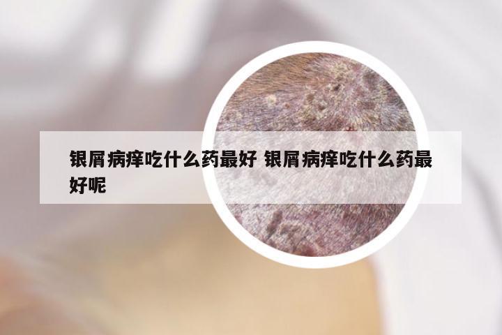 银屑病痒吃什么药最好 银屑病痒吃什么药最好呢