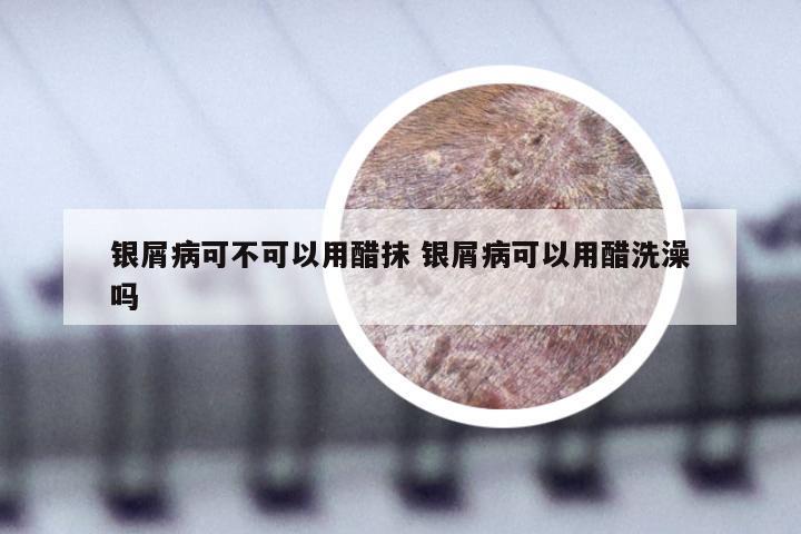 银屑病可不可以用醋抹 银屑病可以用醋洗澡吗